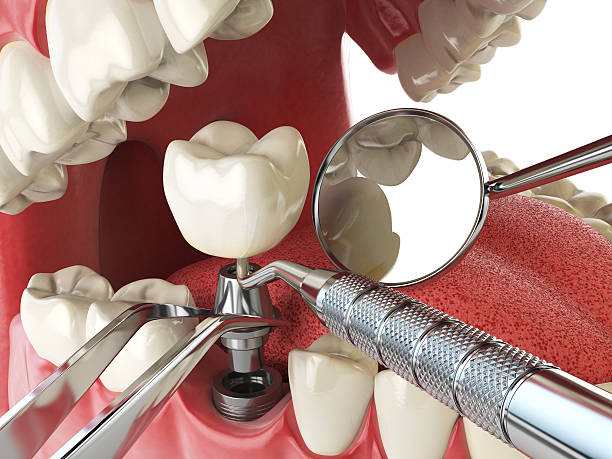 Best Emergency Tooth Extraction in Crescent City, CA